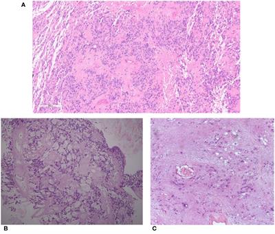 Spinal ependymoma in adults: from molecular advances to new treatment perspectives